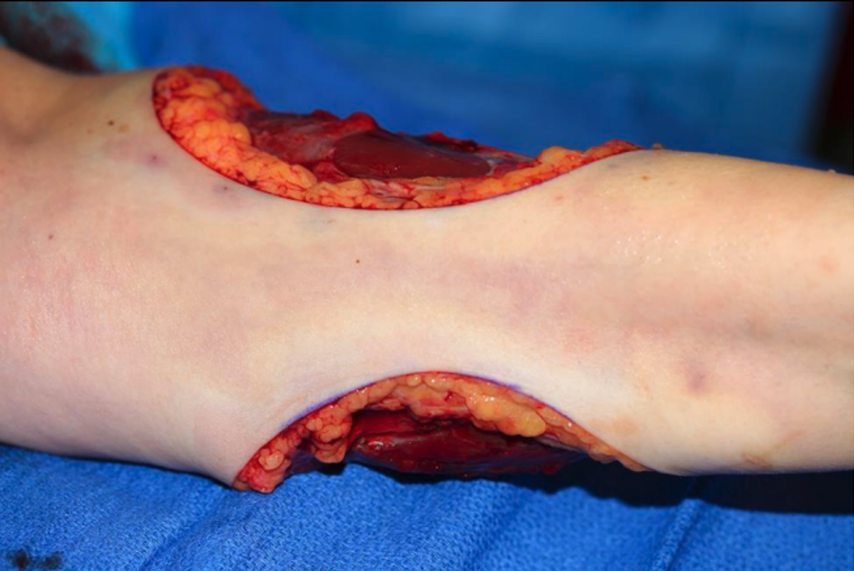 A small skin bridge remains on volar surface