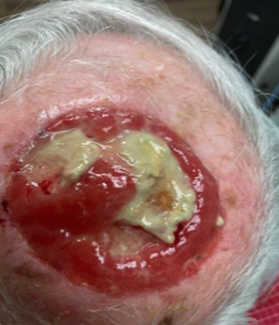 Second post-op visit, day 25