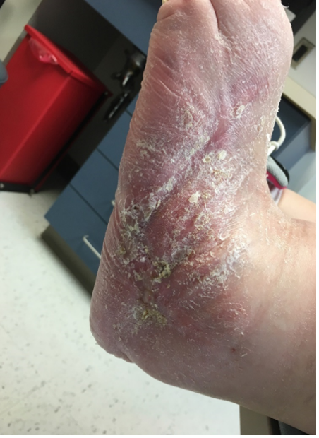 16 weeks after stravix tissue