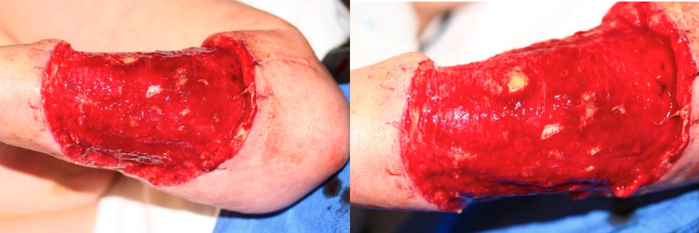 -	Day 12 – day after application of OASIS ULTRA Matrix -	Beefy-red layer of granulation tissue formation at the base of the open wound -	Ready for application of a split thickness skin graft
