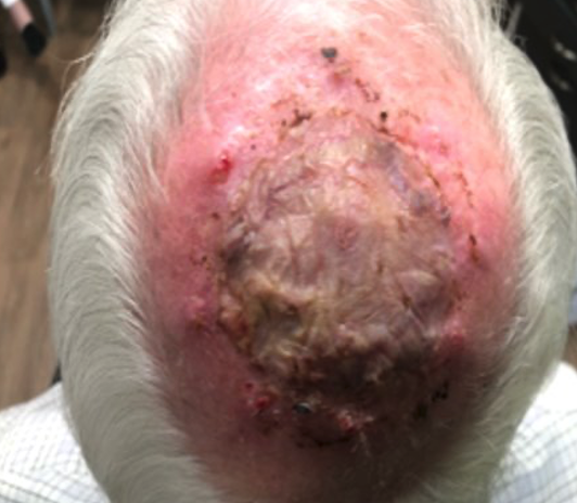 Post-split thickness skin graft, day 36