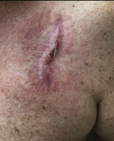 Stravix STRAVIX Tissue Products in the treatment of locoregional head and neck ...
