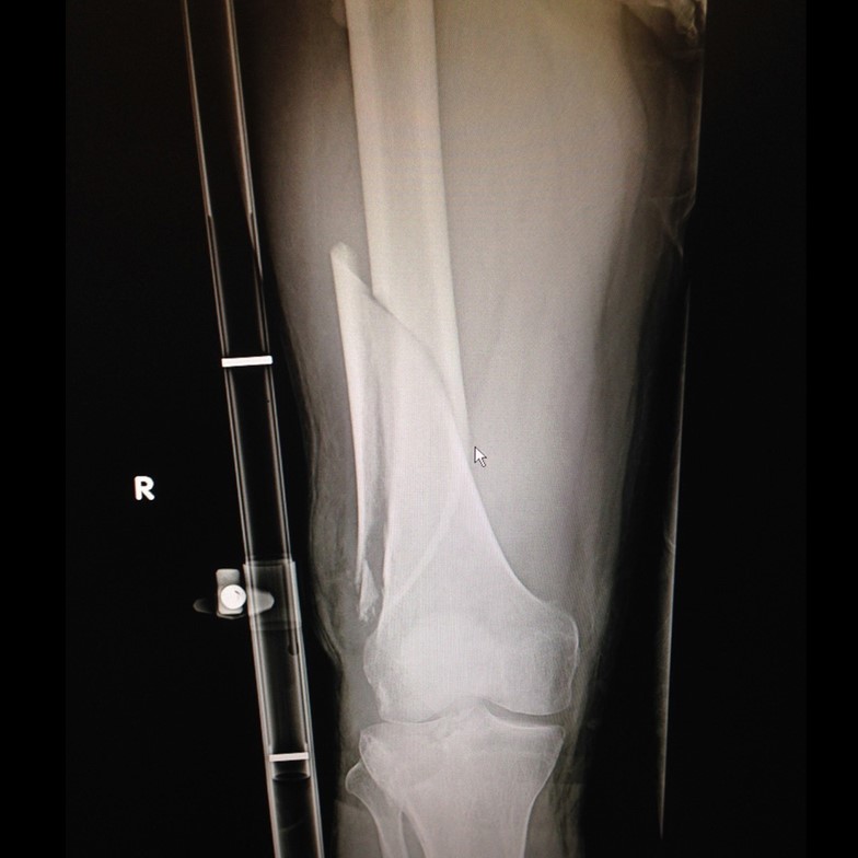 Figure 12: X-ray image, Slishman on a patient (Photo: Rescue Essentials)