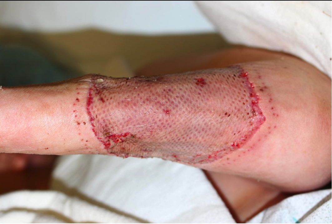 Day 21 – status post-application of a split thickness skin graft