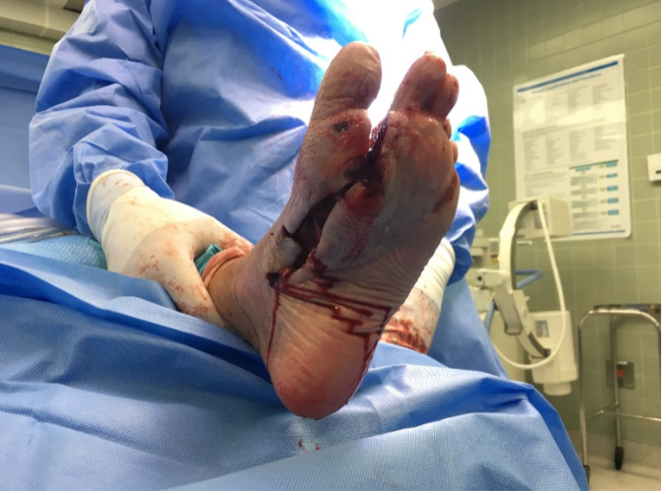 Initial incision and drainage