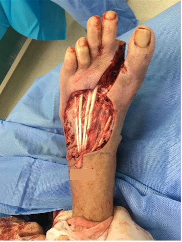 Initial incision and drainage