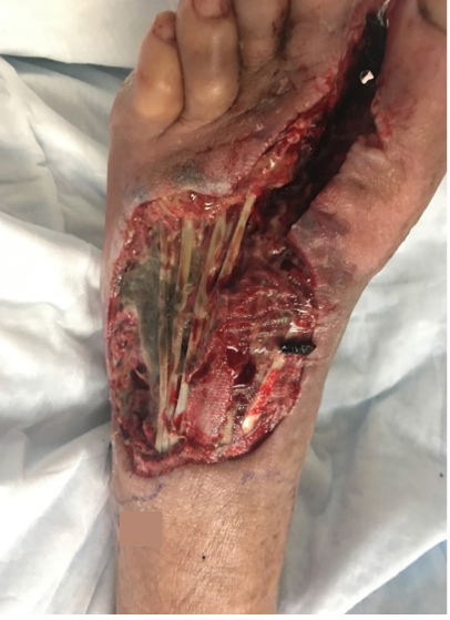 1 week post-op