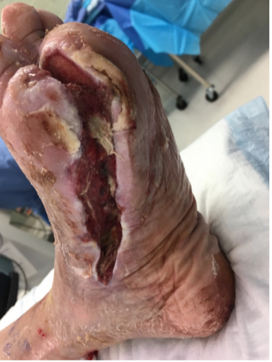 4 weeks post-op