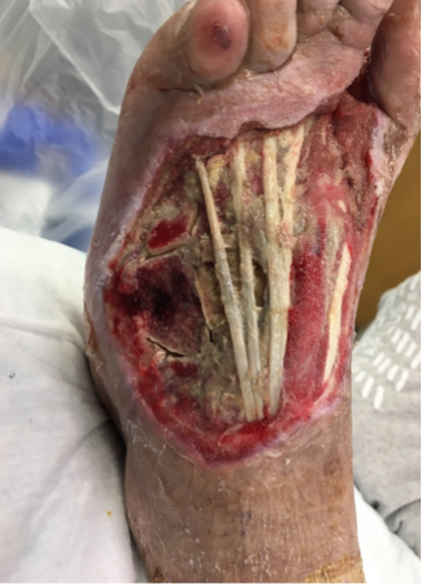 4 weeks post-op