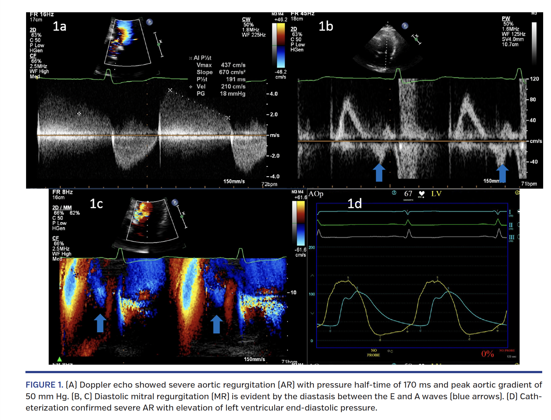 Doppler echo showed severe aortic regurgitation (AR) with pressure half-time of 170 ms and peak aortic gradient of 50 mm Hg.