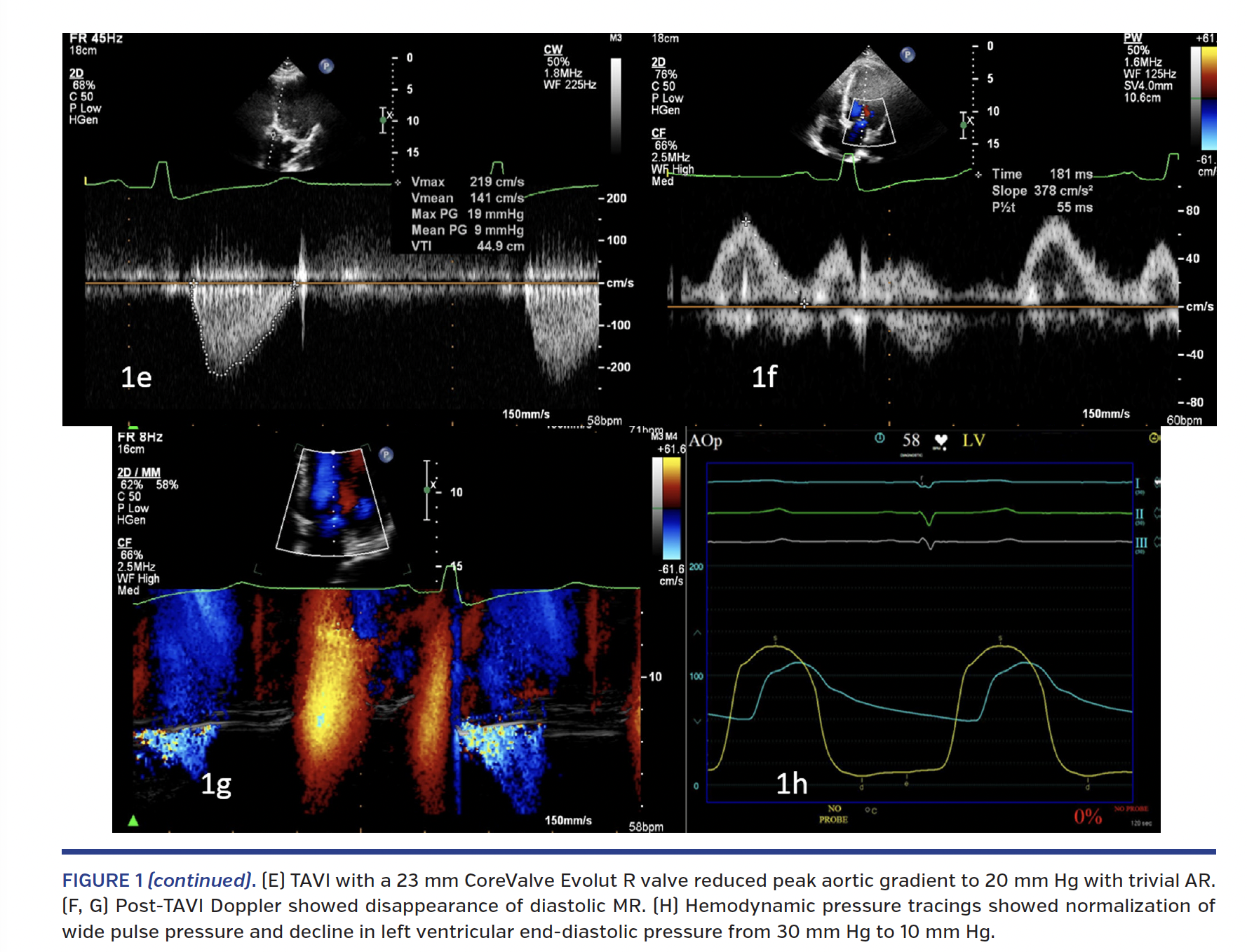 TAVI with a 23 mm CoreValve Evolut R valve reduced peak aortic gradient to 20 mm Hg with trivial AR. (F, G) Post-TAVI Doppler showed disappearance of diastolic MR. (H) Hemodynamic pressure tracings showed normalization of wide pulse pressure and decline in left ventricular end-diastolic pressure from 30 mm Hg to 10 mm Hg.