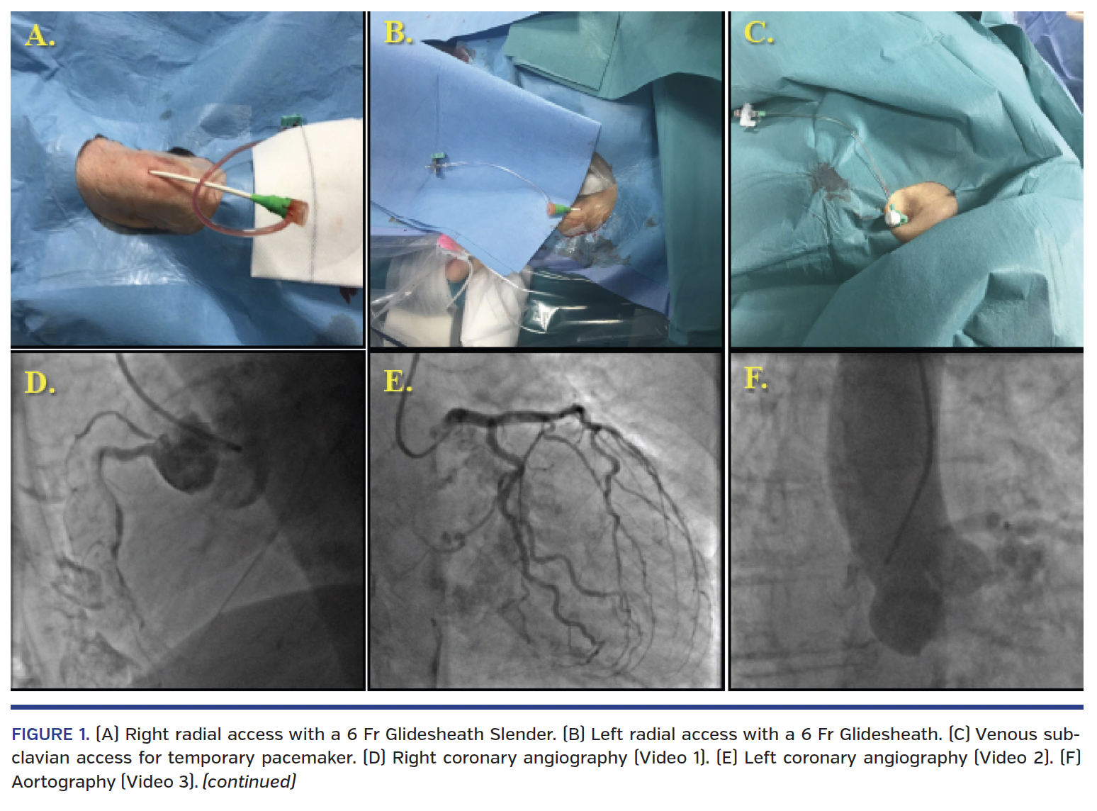 Right radial access with a 6 Fr Glidesheath Slender