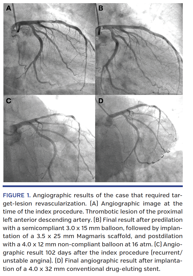 FIGURE 1. Angiographic results of the case that required target- lesion revascularization
