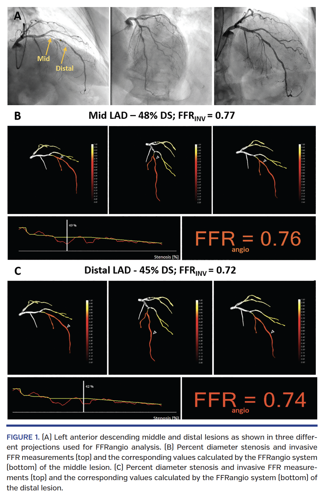 Left anterior descending middle and distal lesions as shown in three different projections used for FFRangio analysis. (