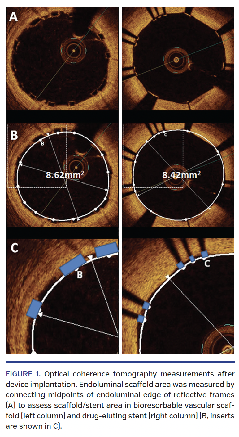 Optical coherence tomography measurements after device implantation. Endoluminal scaffold area was measured by connecting midpoints of endoluminal edge of reflective frames (A) to assess scaffold/stent area in bioresorbable vascular scaffold (left column) and drug-eluting stent (right column) (B, inserts are shown in C).