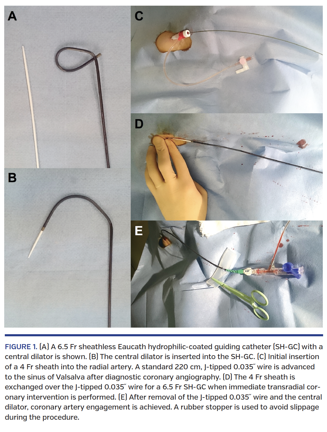   Numerous studies have shown that a transradial approach (TRA) can reduce the incidence of serious vascular complications when compared with a transfemoral approach (TFA).1-4 However, inherent potential complications of TRA include procedural failure because of radial artery spasm (RAS) and postprocedural radial artery occlusion (RAO), which appears to be a barrier to the adoption of TRA. The sheathless Eaucath hydrophilic-coated guiding catheter (SH-GC) (Asahi Intecc) was developed as a therapeutic catheter to overcome these complications. This catheter has a small equipment diameter and a hydrophilic coating, which allow direct insertion into the radial artery without an introducer sheath (Figures 1A and 1B).5-8 The external diameter of a 6.5 Fr SH-GC (2.16 mm) is smaller than a conventional 5 Fr sheath (2.29 mm). Similarly, the external diameter of a 7.5 Fr SH-GC (2.49 mm) is smaller than a conventional 6 Fr sheath (2.62 mm). It has been shown that the SH-GC was feasible for primary transradial coronary intervention (TRI) in consecutive patients with ST-segment elevation myocardial infarction (STEMI) and that there were few incidences of RAS and RAO.9 Primary percutaneous coronary intervention (PCI) is a standard treatment in patients with acute coronary syndrome (ACS); however, an optimal primary TRA system has not yet been established in patients with non-ST segment elevation acute coronary syndrome (NSTEACS). NSTEACS patients do not always undergo immediate PCI after diagnostic angiography, and primary medical management with elective revascularization is often preferred.10,11 We hypothesized that we could perform immediate TRI using SH-GC after coronary angiography (CAG) without an additional large sheath. Moreover, initial CAG could be conducted using a small sheath system if the SH-GC was chosen. The primary purpose of the present interventional trial was therefore to prospectively investigate whether immediate TRI with one SH-GC via a single puncture site could be successfully performed after diagnosti