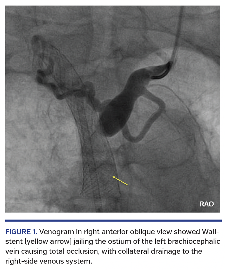 Culotte Stenting for Jailed Left Subclavian Occlusion