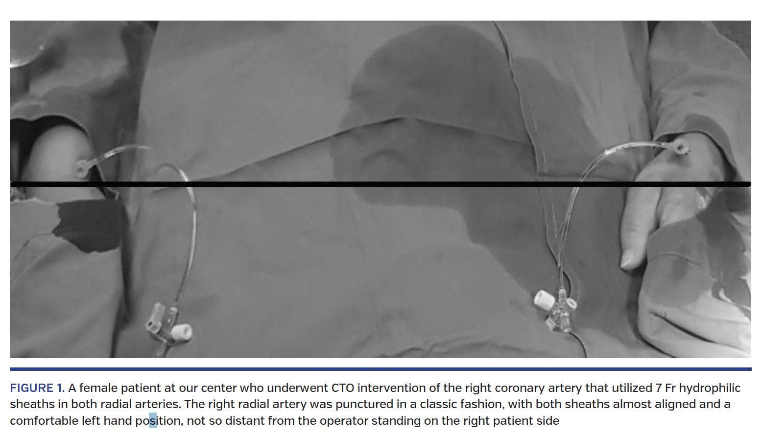 FIGURE 1. A female patient at our center who underwent CTO intervention of the right coronary artery that utilized 7 Fr hydrophilic sheaths in both radial arteries. The right radial artery was punctured in a classic fashion, with both sheaths almost aligned and a comfortable left hand position, not so distant from the operator standing on the right patient side