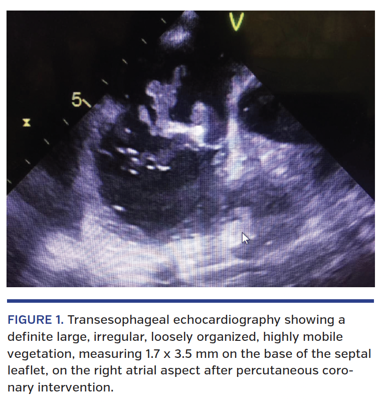 FIGURE 1. Transesophageal echocardiography showing a definite large, irregular, loosely organized, highly mobile vegetation, measuring 1.7 x 3.5 mm on the base of the septal leaflet, on the right atrial aspect after percutaneous coronary intervention.