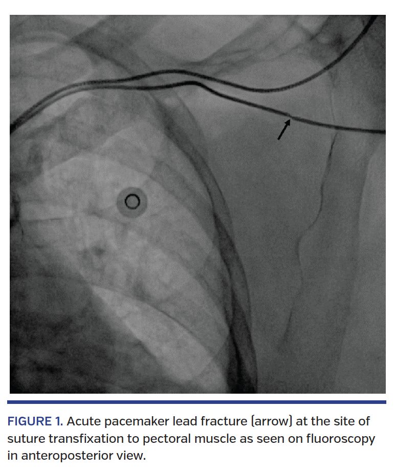 FIGURE 1. Acute pacemaker lead fracture (arrow) at the site of suture transfixation to pectoral muscle as seen on fluoroscopy in anteroposterior view.