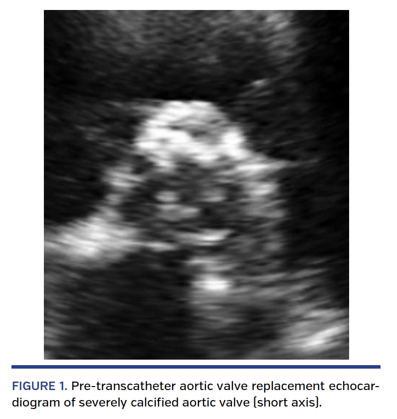 FIGURE 1. Pre-transcatheter aortic valve replacement echocardiogram of severely calcified aortic valve (short axis).