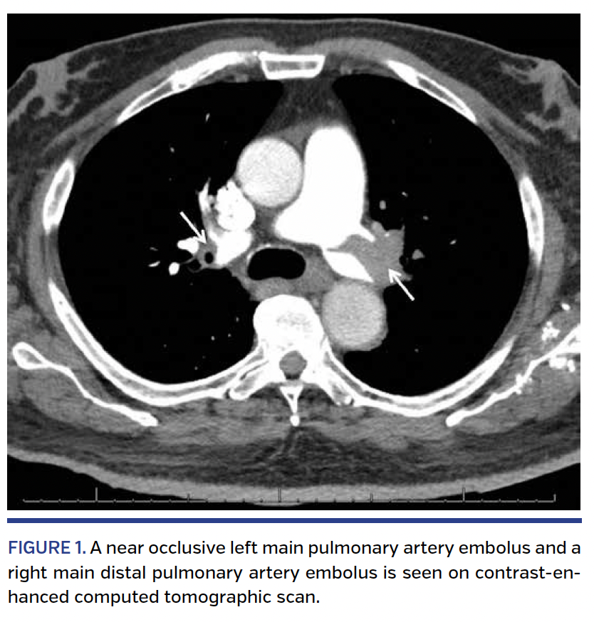 FIGURE 1. A near occlusive left main pulmonary artery embolus and a right main distal pulmonary artery embolus is seen on contrast-enhanced computed tomographic scan.