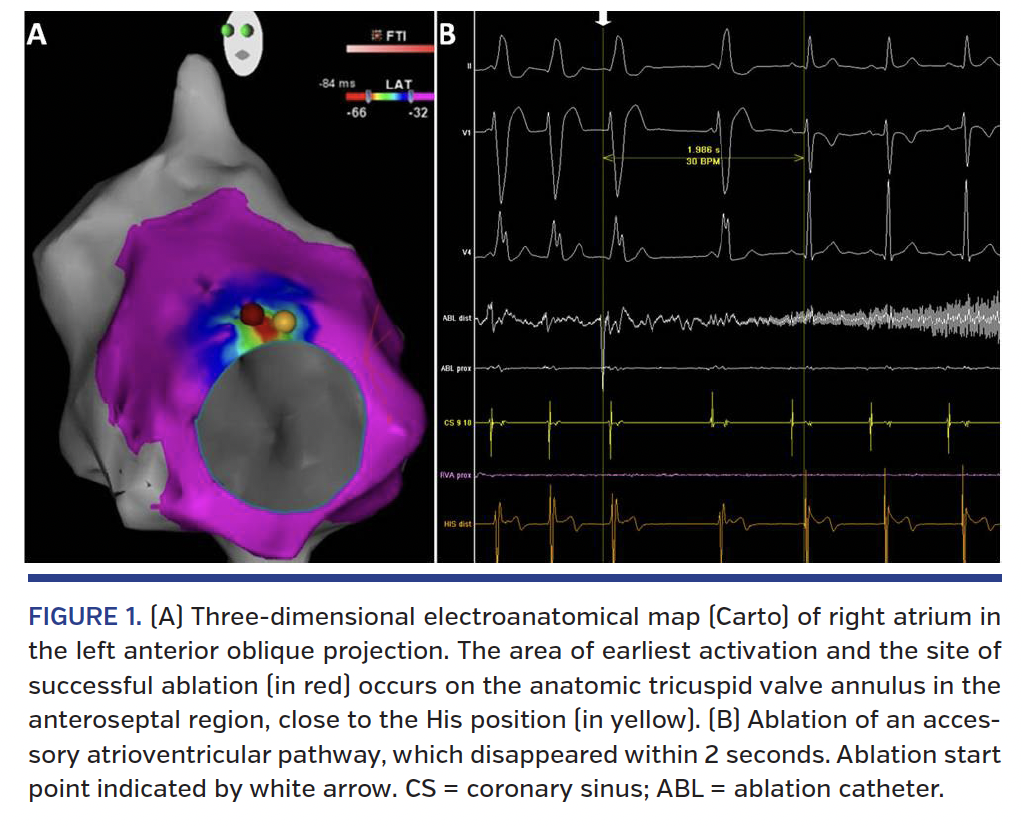 Successful Cryoablation of an Anteroseptal Accessory Pathway