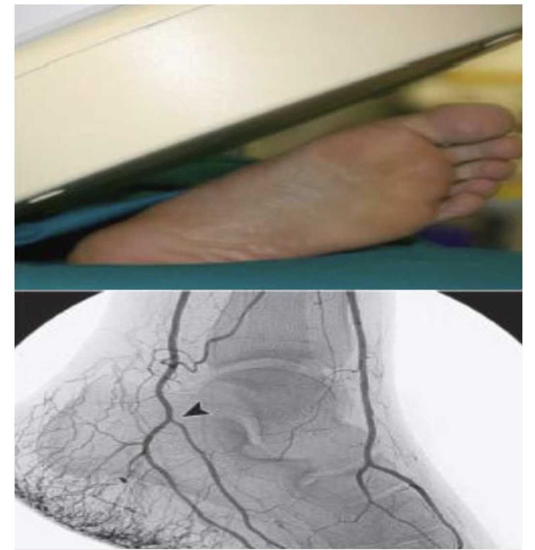 Figure 1. Upper view revealing positioning of the image intensifier in the lateral oblique view to adequately assess the fifth metatarsal bone and evaluate the lateral aspect of the pedal arch. Lower image revealing the angiographic view expected.