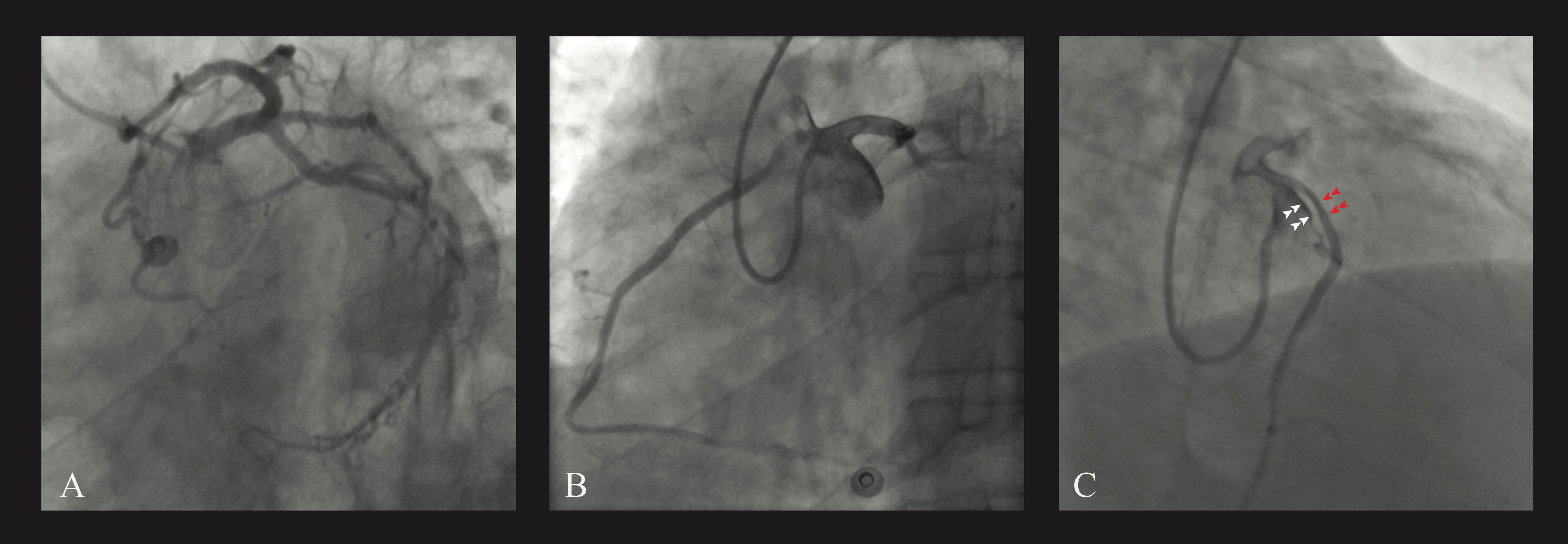 Figure 1. Coronary angiogram