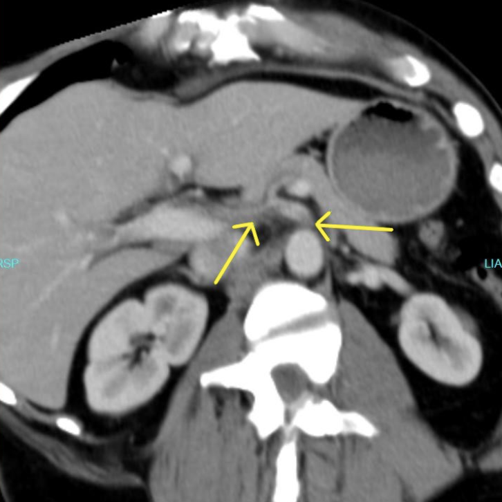 Figure 1. Arrows showing narrowed celiac origin and poststenotic dilatation with celiac artery dissection. 