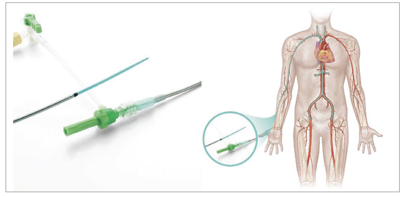 Figure 1. 6 Fr Radial to Peripheral (R2P) Destination Slender Guiding Sheath (Terumo Medical Corporation) with hydrophilic coating designed to provide transradial access to the peripheral vasculature for interventional procedures.