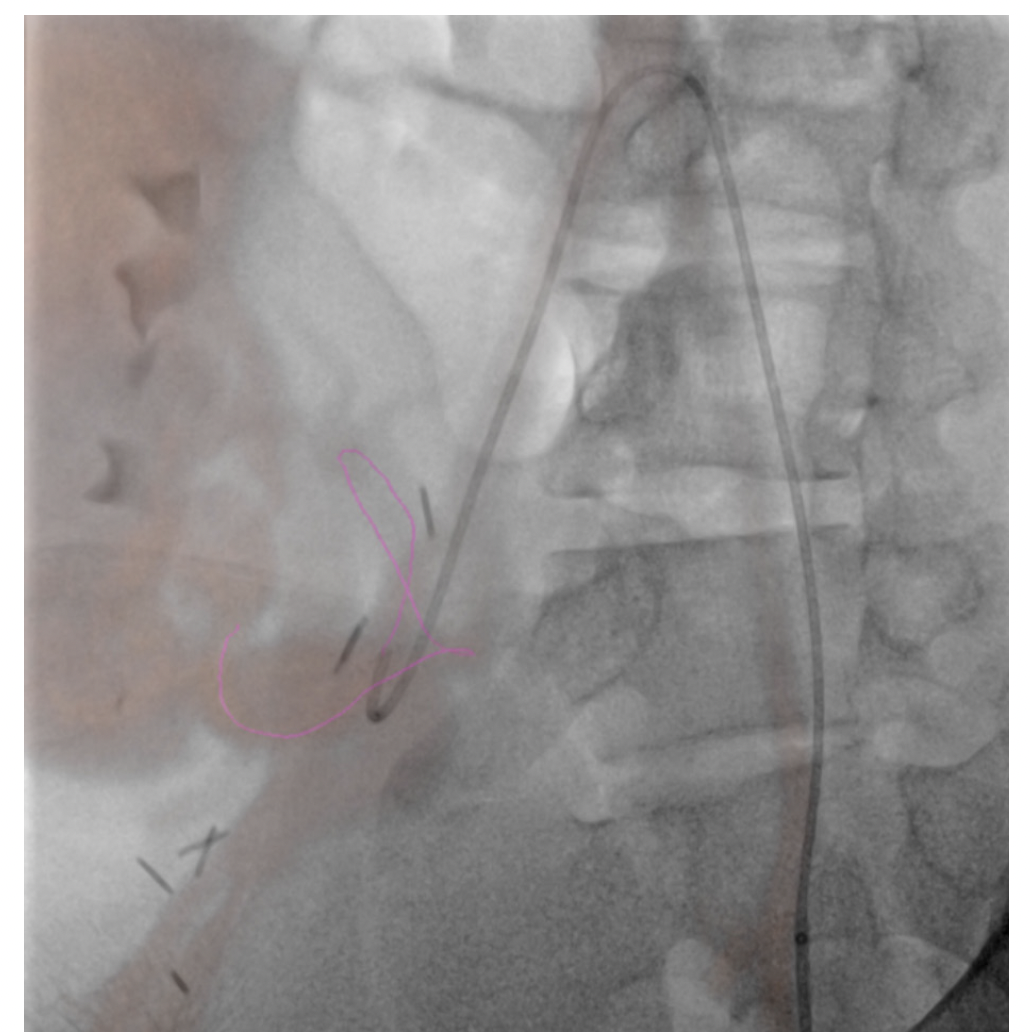 Figure 1. 3D roadmap created with the patient’s previous cross-sectional imaging overlaid on live fluoroscopy. 