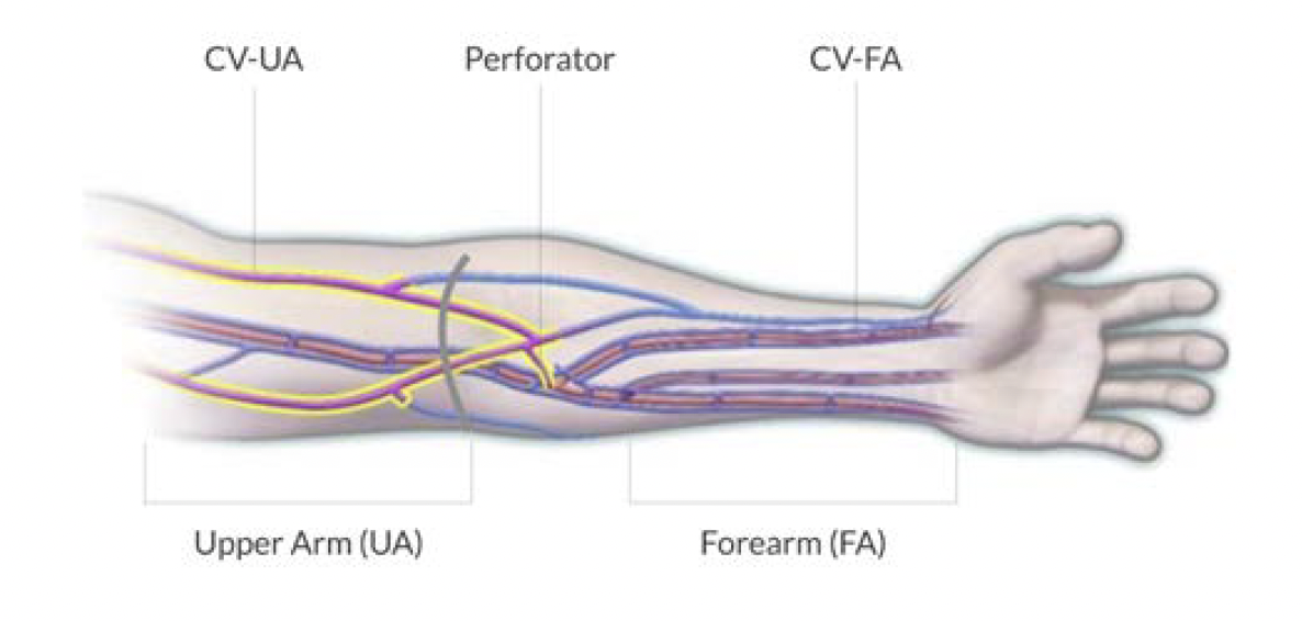 Figure 1. Arm perforator location measurement site (CV = cephalic vein).