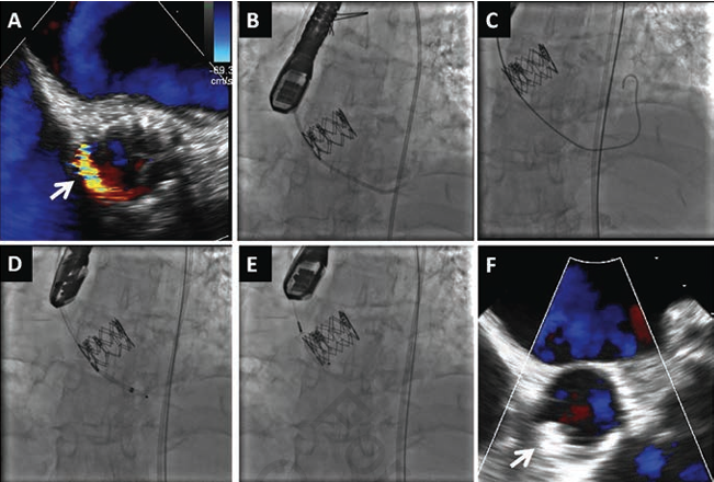 FIGURE 1. Percutaneous paravalvular leak (PVL) closure. (A) Preprocedural transesophageal echocardiogram (TEE) revealed significant PVL (arrow). (B) The defect site was crossed with a hydrophilic guidewire and a support catheter was then advanced. (C) A support wire was advanced into the left ventricle. (D, E) An appropriately sized delivery sheath was introduced into the left ventricle. The distal end of the Vascular Plug II device (AGA Medical) was expanded below the aortic valve. The device was then pulled back into the defect and deployed completely. (F) A postprocedural TEE revealed no PVL. The arrow indicates the Vascular Plug II device.