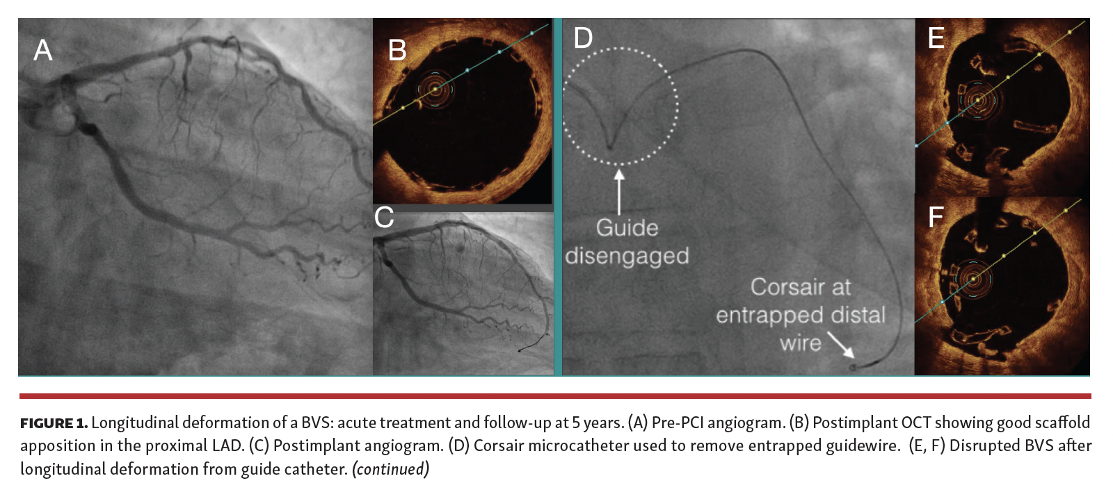 Longitudinal deformation of a BVS: acute treatment and follow-up at 5 years.