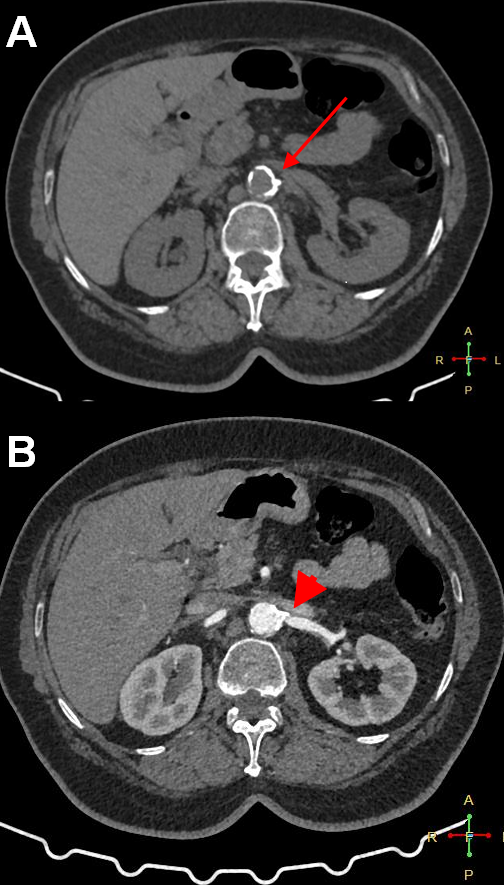 Figure 1.  Computed tomography angiography