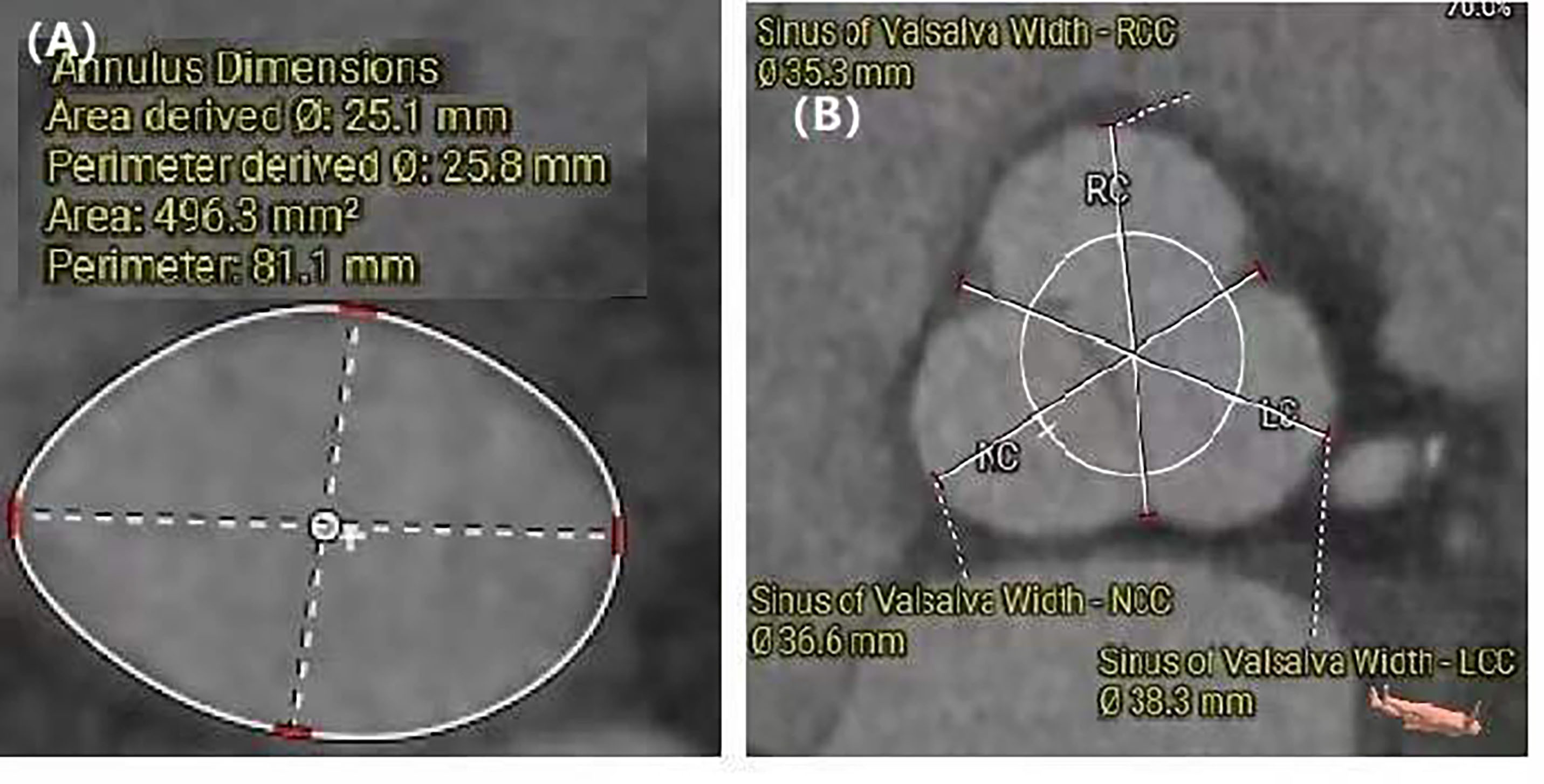 Figure 1. Computed tomography angiography