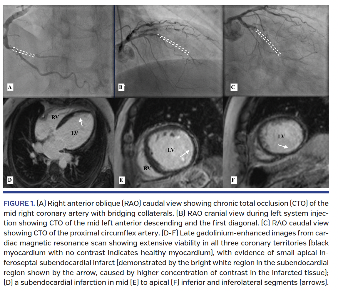 Right anterior oblique (RAO) caudal view showing chronic total occlusion (CTO)