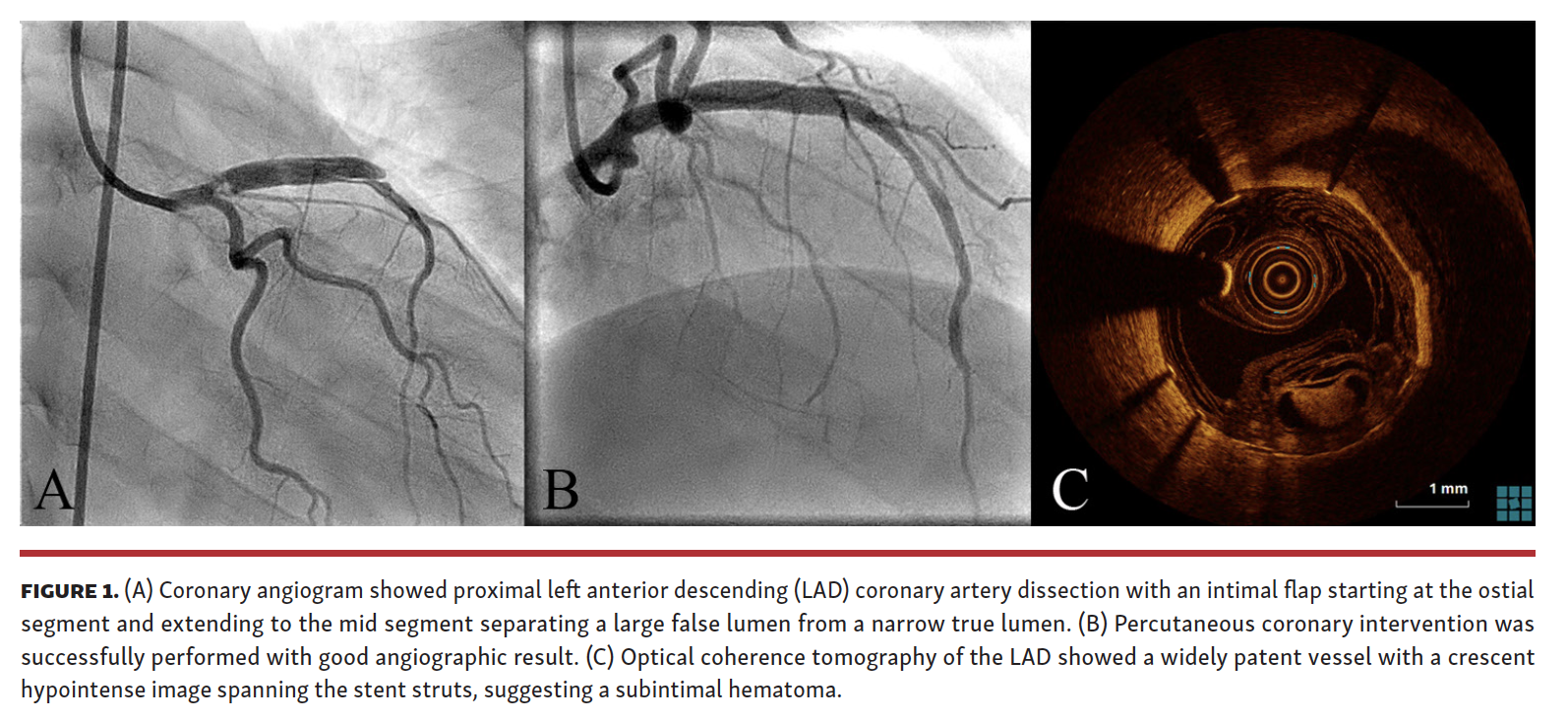 Coronary angiogram showed proximal left anterior descending (LAD) coronary artery dissection with an intimal flap starting at the ostial segment and extending to the mid segment separating a large false lumen from a narrow true lumen. (B) Percutaneous coronary intervention was successfully performed with good angiographic result. (C) Optical coherence tomography of the LAD showed a widely patent vessel with a crescent hypointense image spanning the stent struts, suggesting a subintimal hematoma.