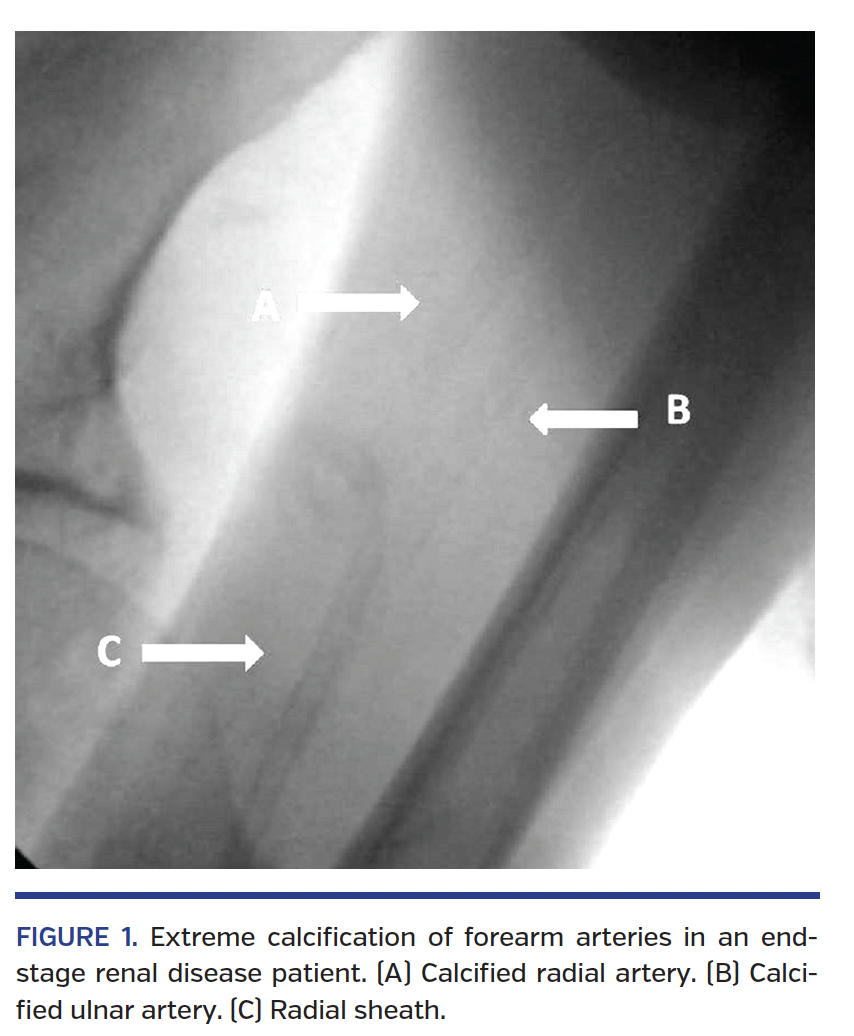 FIGURE 1. Extreme calcification of forearm arteries in an endstage renal disease patient. (A) Calcified radial artery. (B) Calcified ulnar artery. (C) Radial sheath.