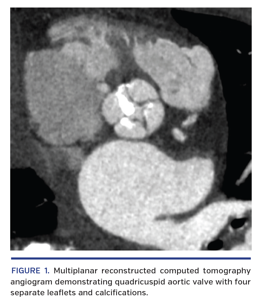 FIGURE 1. Multiplanar reconstructed computed tomography angiogram demonstrating quadricuspid aortic valve with four separate leaflets and calcifications