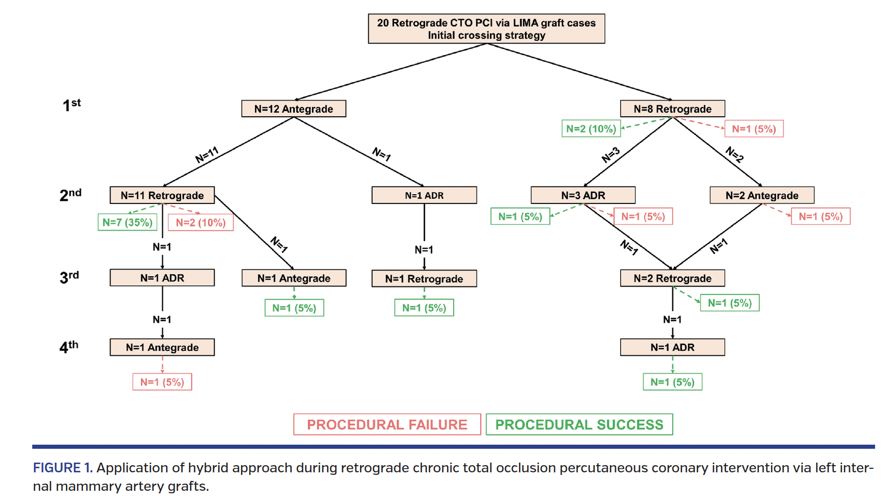 FIGURE 1. Application of hybrid approach during retrograde chronic total occlusion percutaneous coronary intervention via left internal mammary artery grafts.