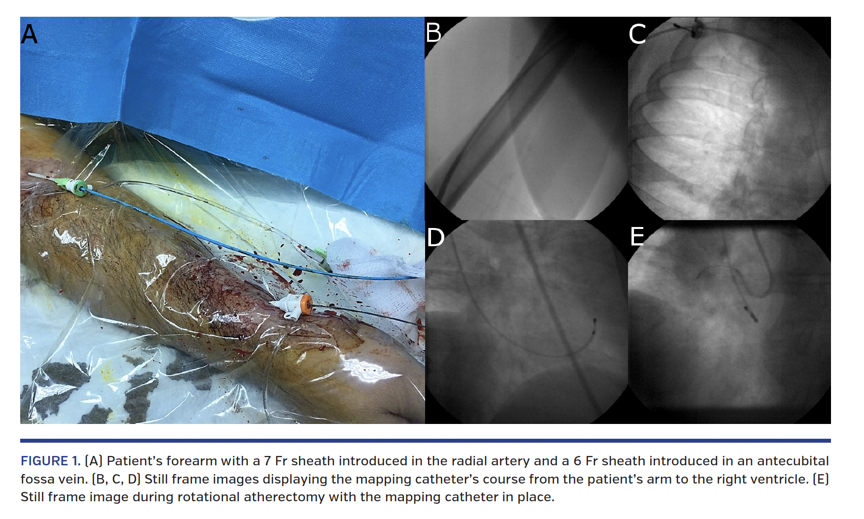 FIGURE 1. (A) Patient’s forearm with a 7 Fr sheath introduced in the radial artery and a 6 Fr sheath introduced in an antecubital fossa vein. (B, C, D) Still frame images displaying the mapping catheter’s course from the patient’s arm to the right ventricle. (E) Still frame image during rotational atherectomy with the mapping catheter in place.