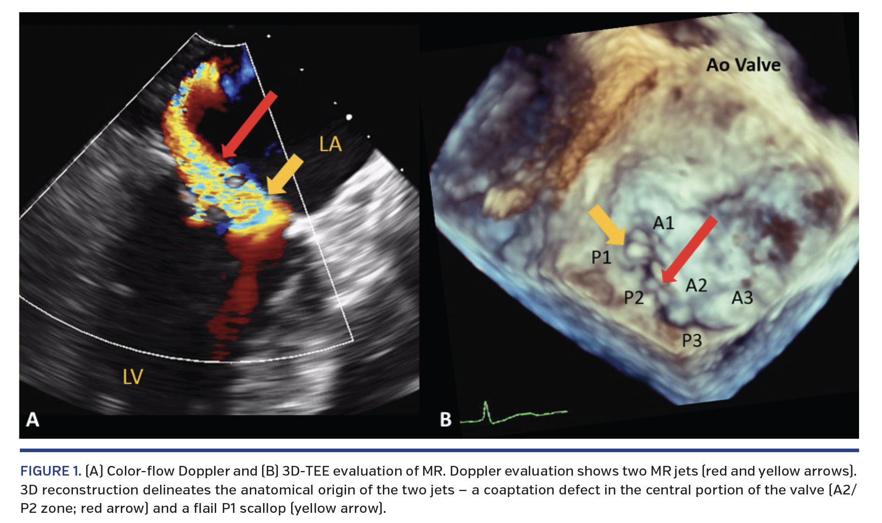 FIGURE 1. (A) Color-flow Doppler and (B) 3D-TEE evaluation of MR. Doppler evaluation shows two MR jets (red and yellow arrows). 3D reconstruction delineates the anatomical origin of the two jets — a coaptation defect in the central portion of the valve (A2/ P2 zone; red arrow) and a flail P1 scallop (yellow arrow).