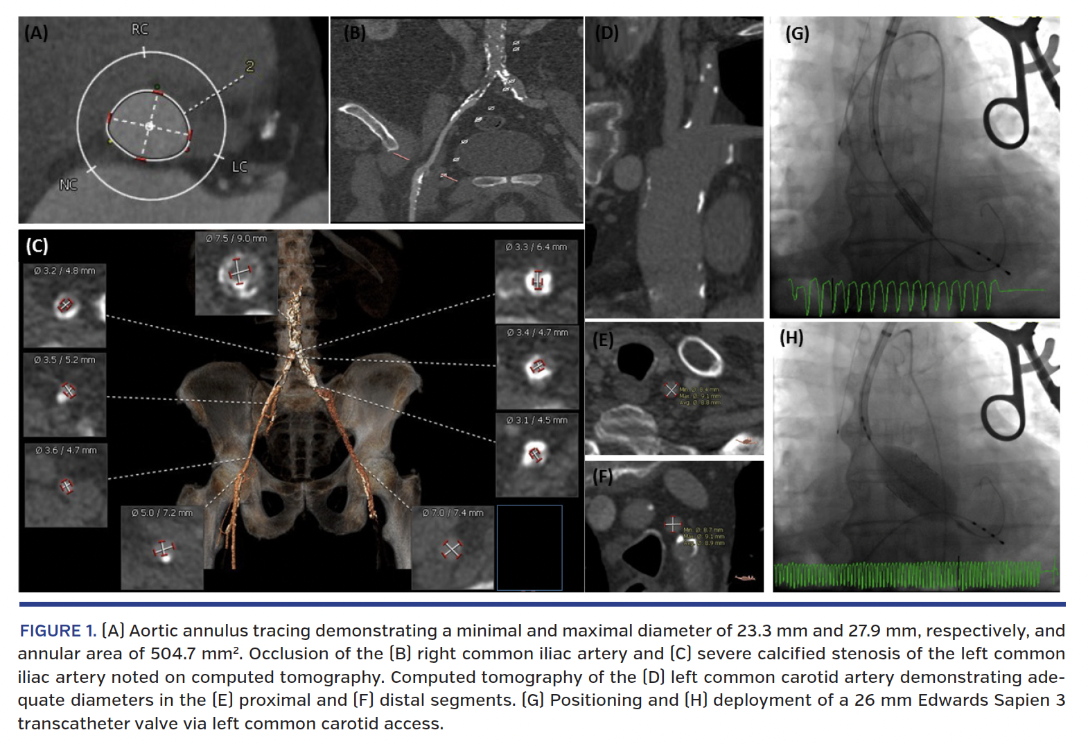Aortic annulus tracing demonstrating a minimal and maximal diameter of 23.3 mm and 27.9 mm, respectively, and annular area of 504.7 mm2.