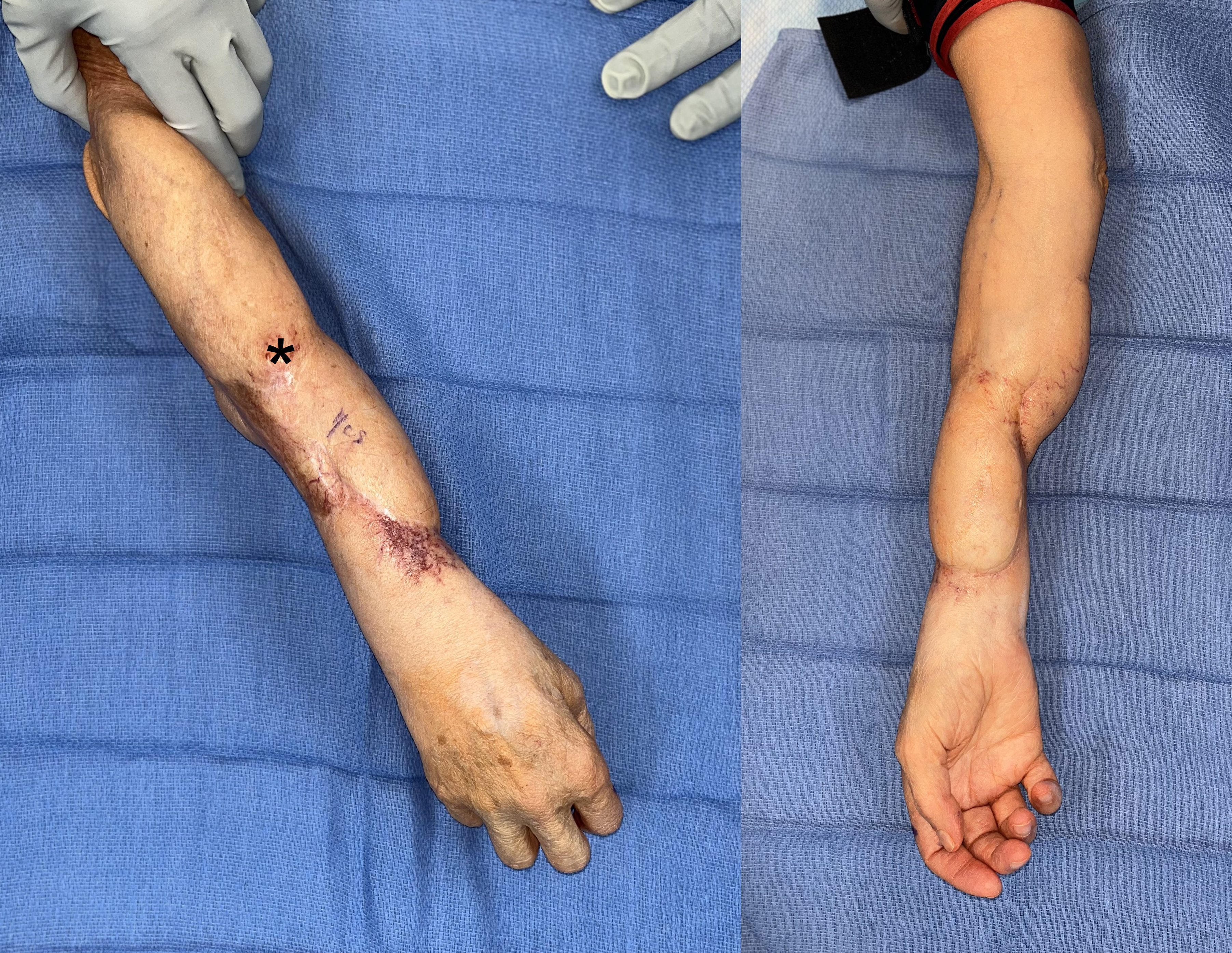 Figure 1: The right arm was previously reconstructed with skin grafting, a lateral arm, and medial sural artery perforator free flaps. The asterisk (*) notes the site of recurrence.
