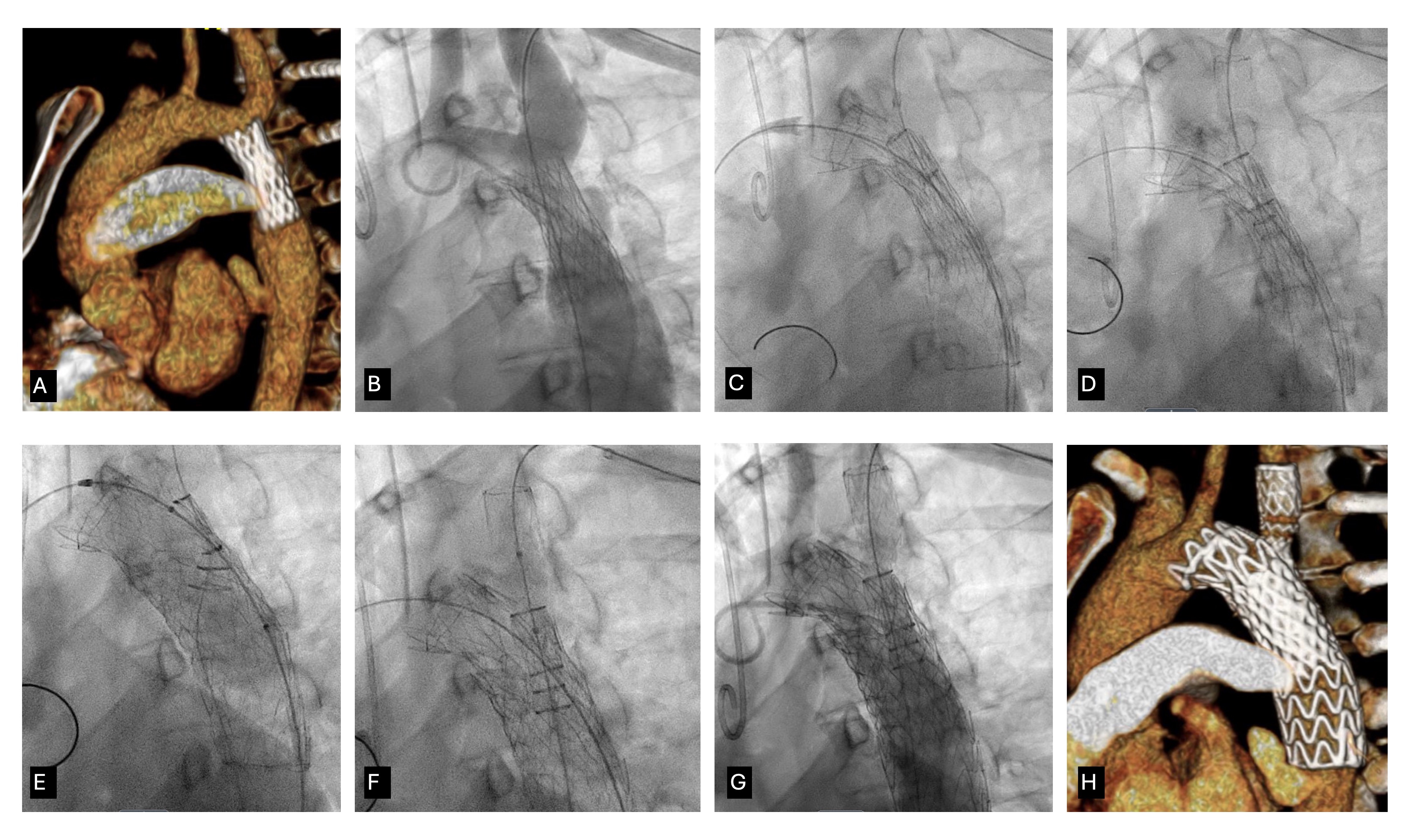 Figure. (A) Computed tomography (CT) showed recurrent coarctation