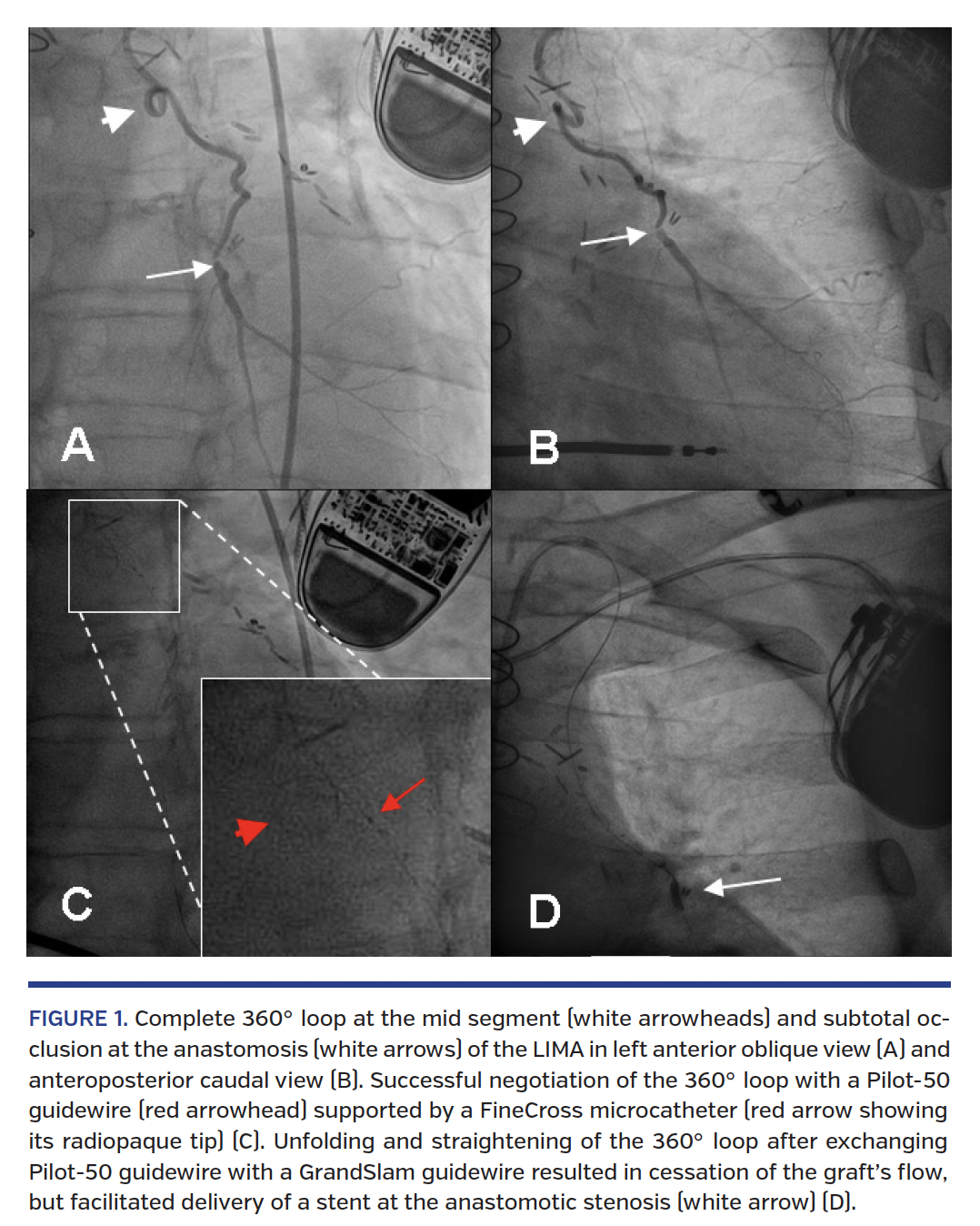 FIGURE 1. Complete 360  loop at the mid segment (white arrowheads) and subtotal occlusion at the anastomosis (white arrows) of the LIMA in left anterior oblique view (A) and anteroposterior caudal view
