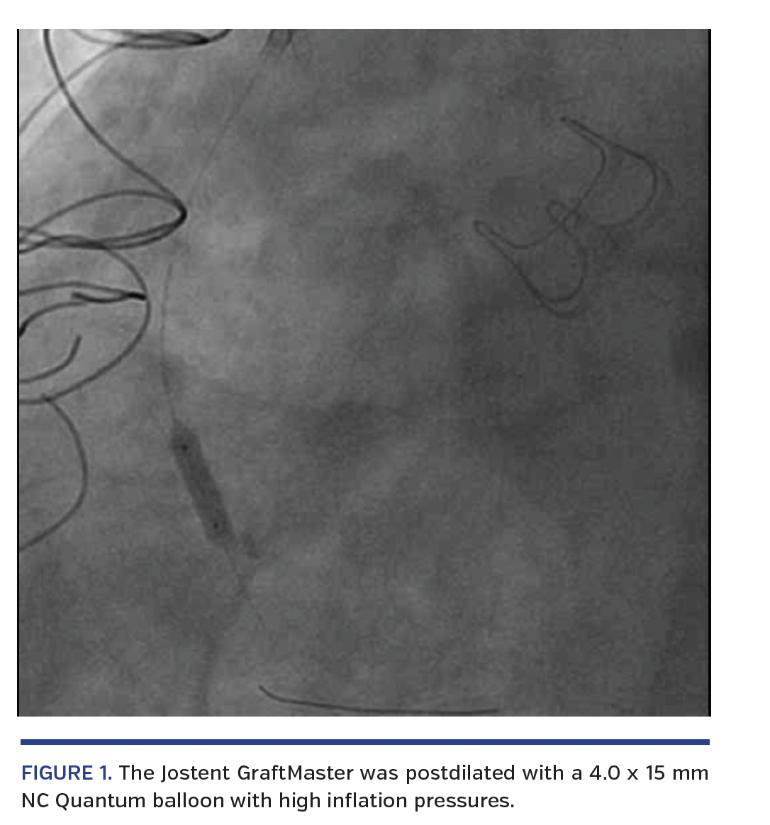 FIGURE 1. The Jostent GraftMaster was postdilated with a 4.0 x 15 mm NC Quantum balloon with high inflation pressures.
