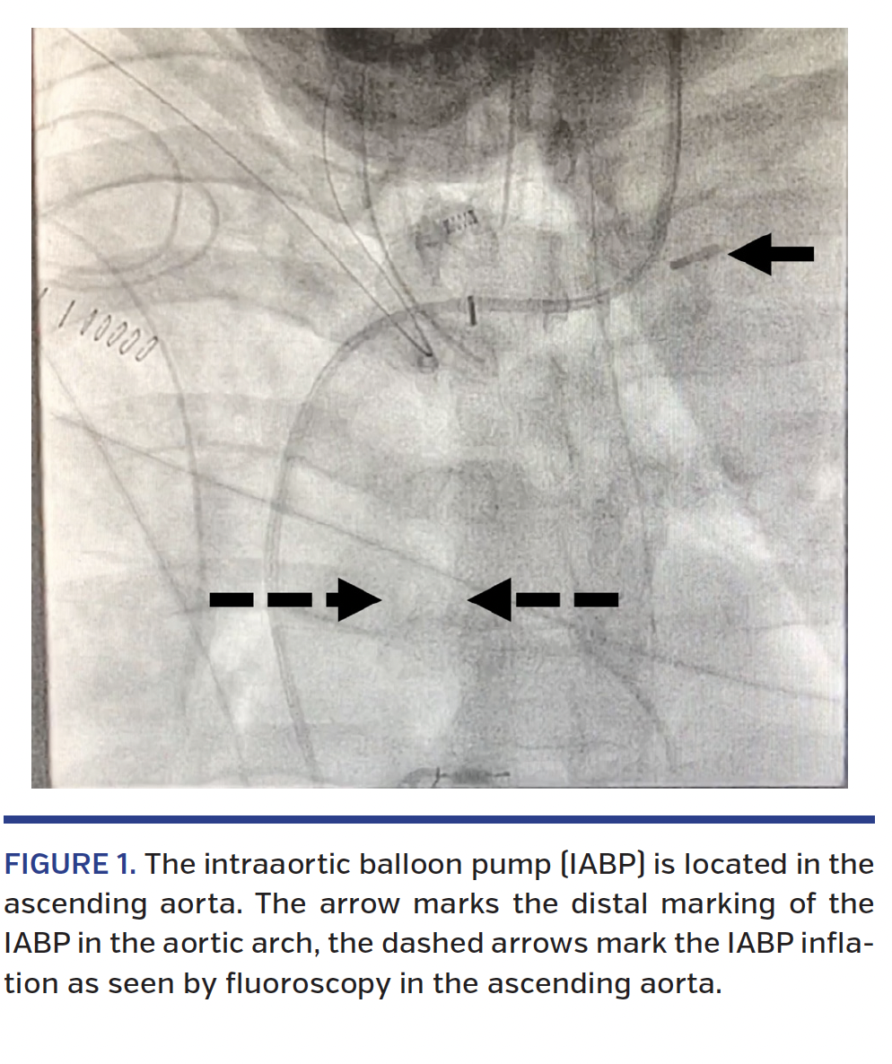 The intraaortic balloon pump (IABP) is located in the ascending aorta. The arrow marks the distal marking of the IABP in the aortic arch, the dashed arrows mark the IABP inflation as seen by fluoroscopy in the ascending aorta.
